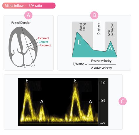 lv ee|Mitral E/E’ ratio on echocardiogram .